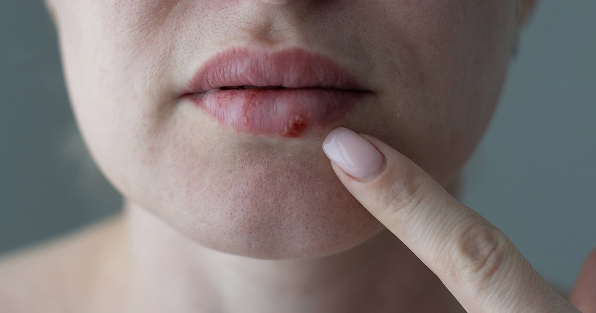 Un antiviral oral nuevo para el herpes resistente: la FDA avala un fármaco que llega tras casi treinta años sin novedades